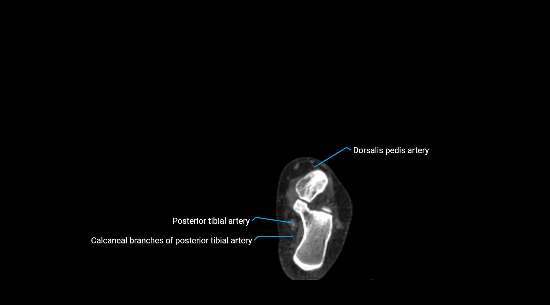 CTA lower limb cross sectional anatomy labelled image _280.webp